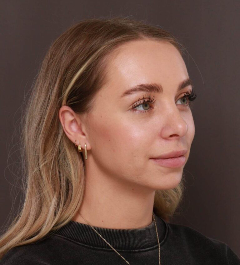 After Image: Rhinoplasty by Dr. Henstrom - right-front-oblique