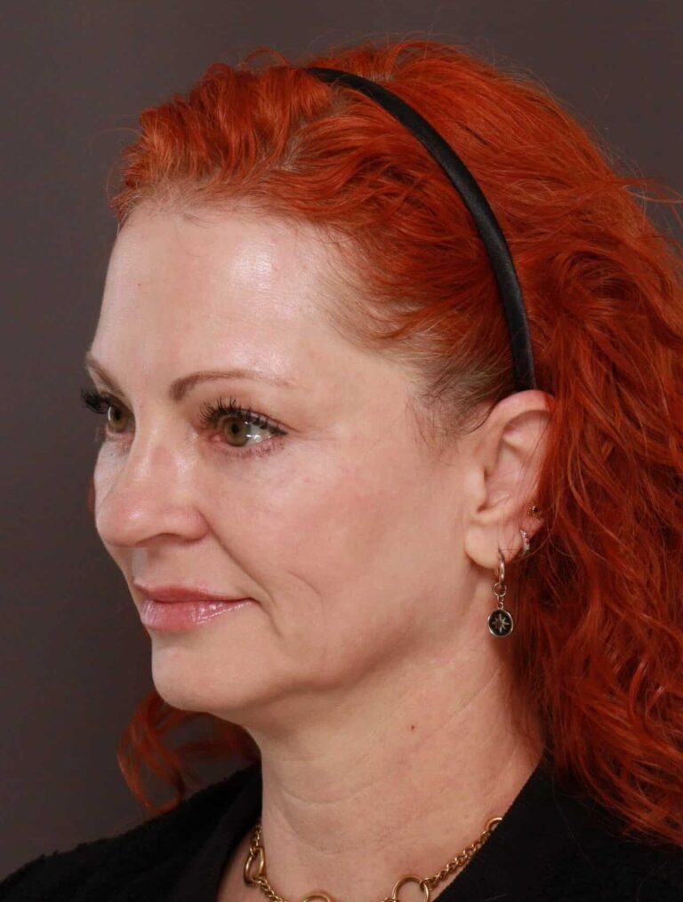 After Image: Lower Blepharoplasty with Fat Grafting by Dr. Henstrom - right-front-oblique