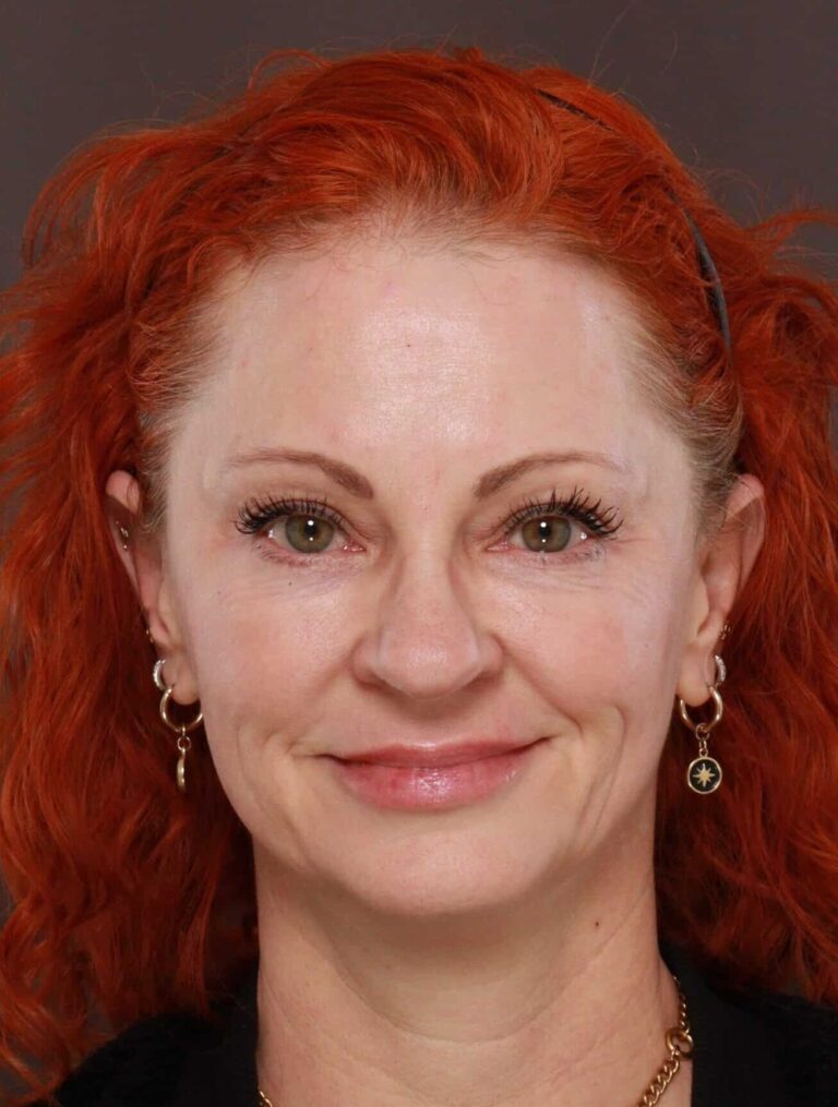 After Image: Lower Blepharoplasty with Fat Grafting by Dr. Henstrom - front