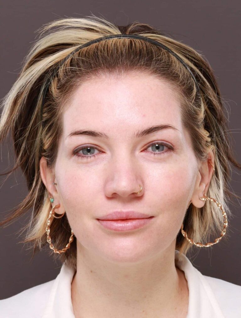 After Image: Moxi Laser Resurfacing - front