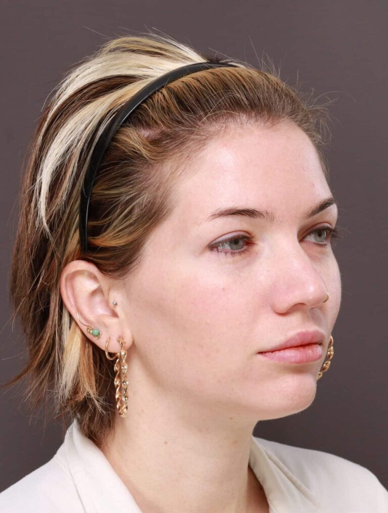 After Image: Moxi Laser Resurfacing - right-front-oblique