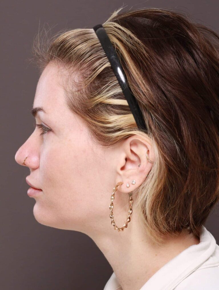 After Image: Moxi Laser Resurfacing - left-side