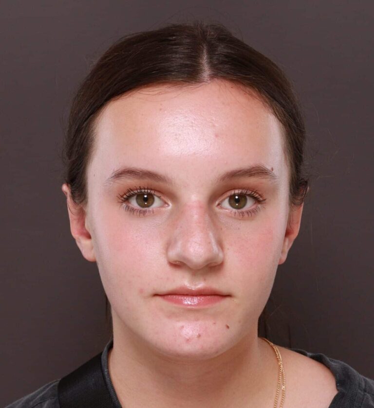 After Image: Otoplasty by Dr. Thompson - front