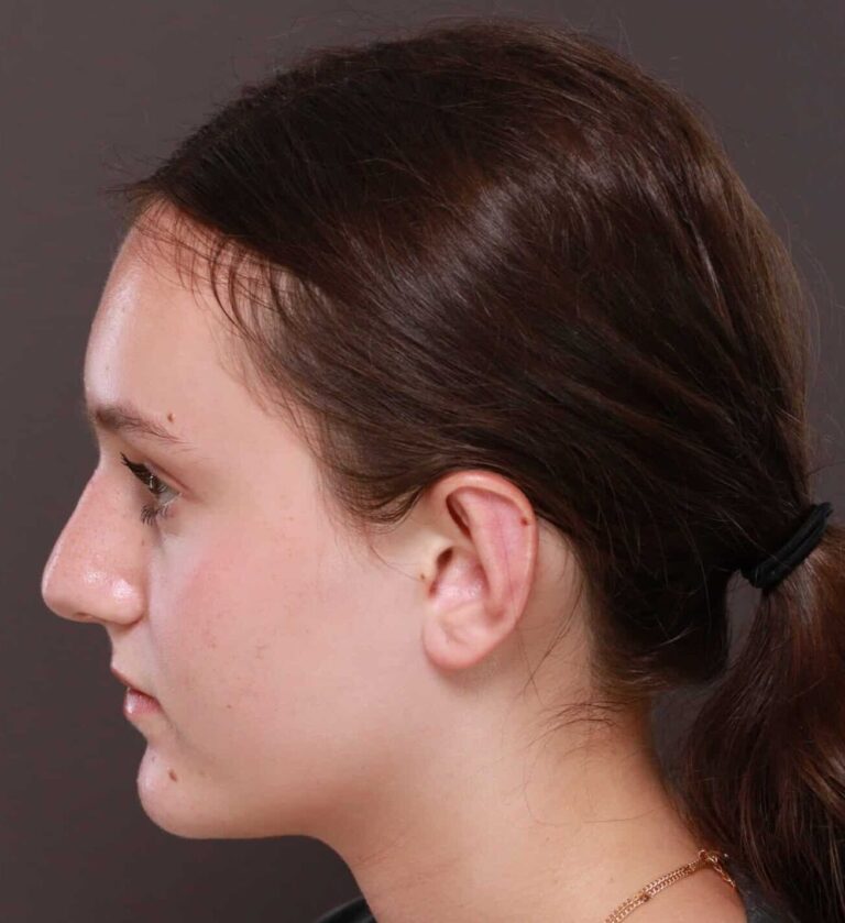 After Image: Otoplasty by Dr. Thompson - left-side