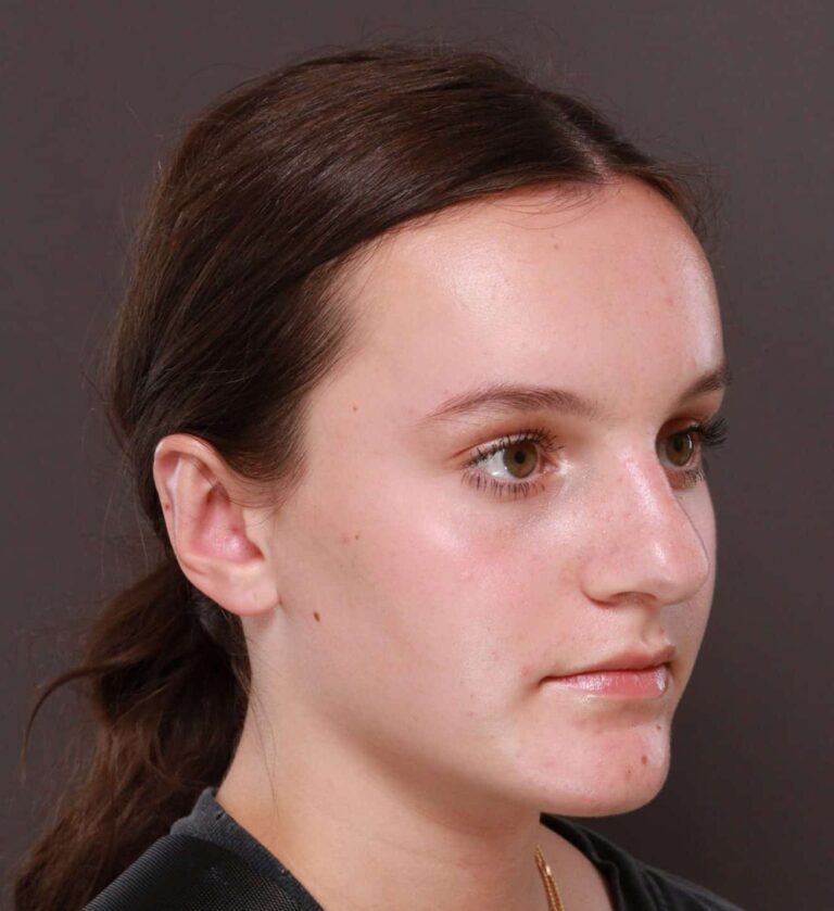 After Image: Otoplasty by Dr. Thompson - right-front-oblique