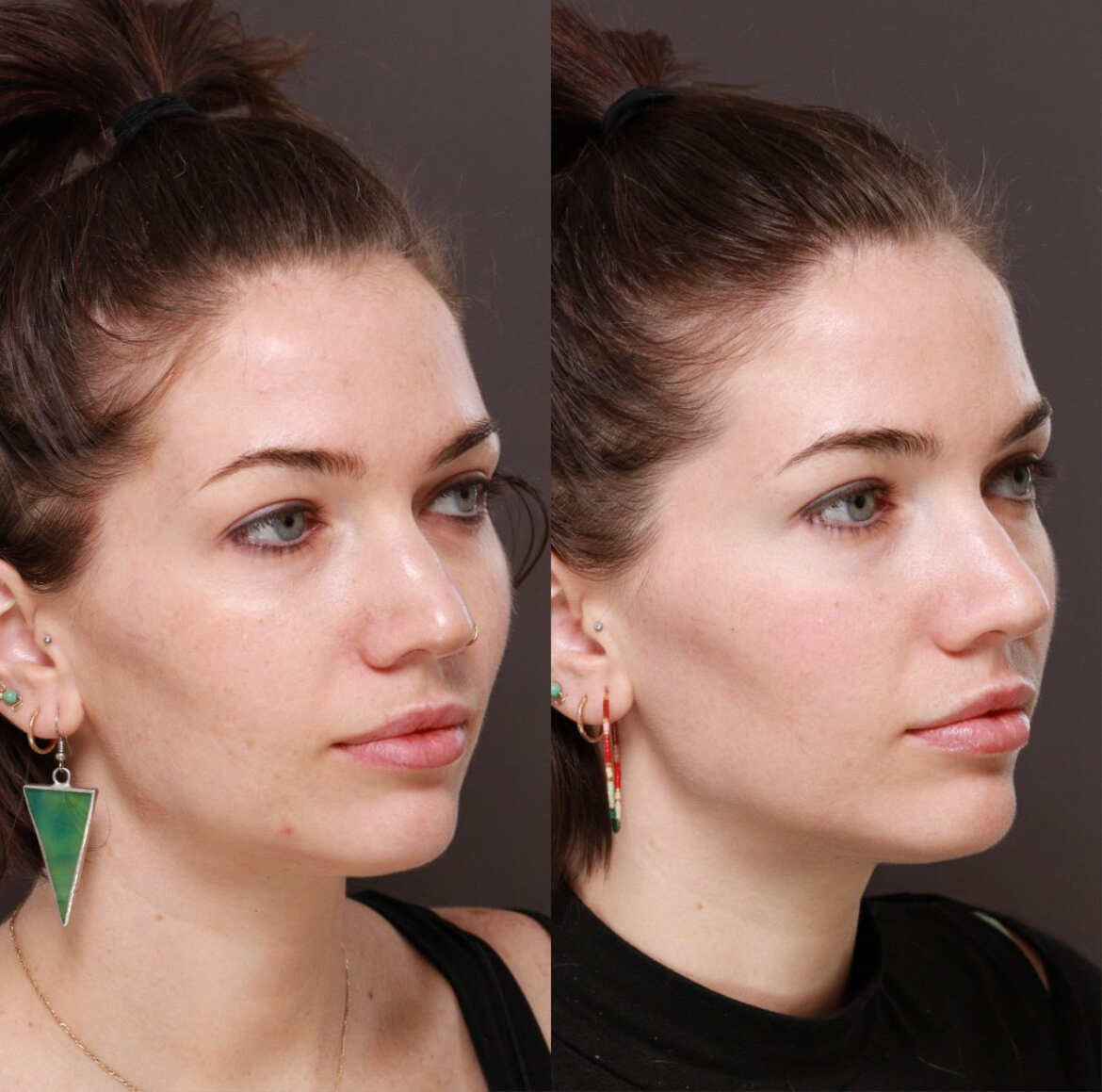 How Much Does Moxi Laser Cost? Utah Facial Plastics