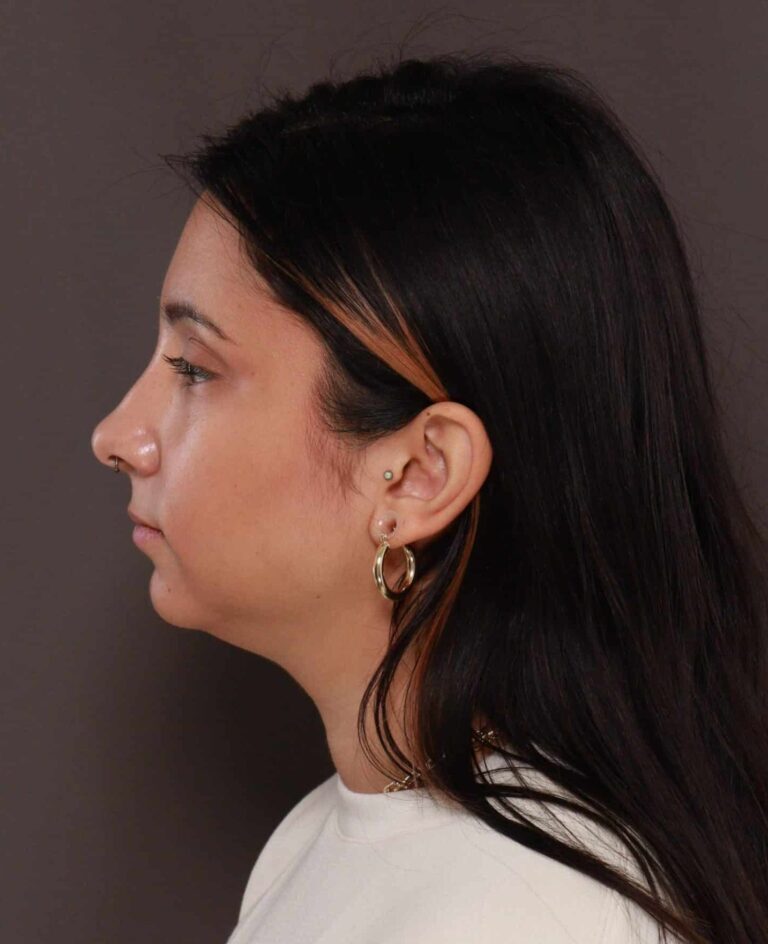 Before Image: Deep Neck Contouring by Dr. Manning - front