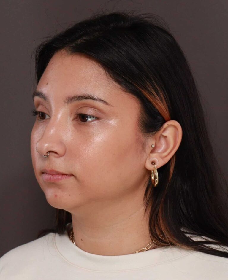 Before Image: Deep Neck Contouring by Dr. Manning - left-front-oblique