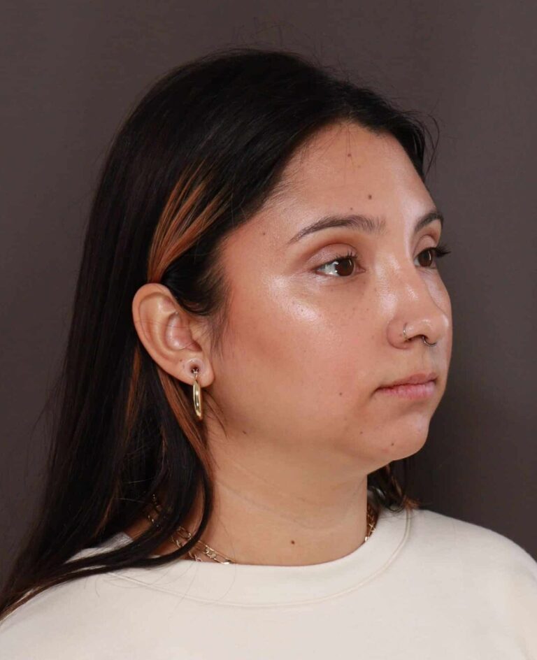 Before Image: Deep Neck Contouring by Dr. Manning - right-front-oblique