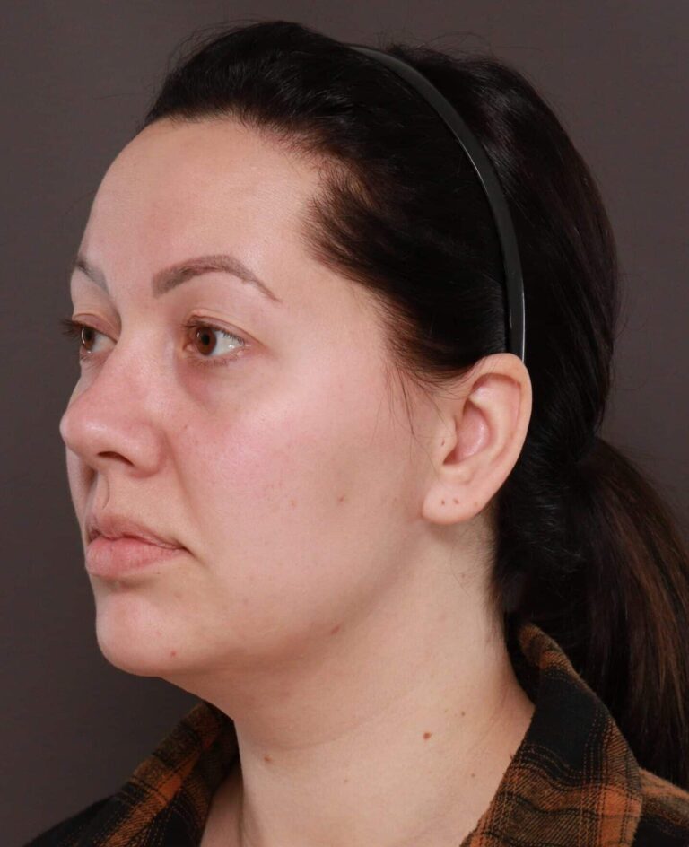 Before Image: Deep Neck Contouring by Dr. Manning - left-front-oblique