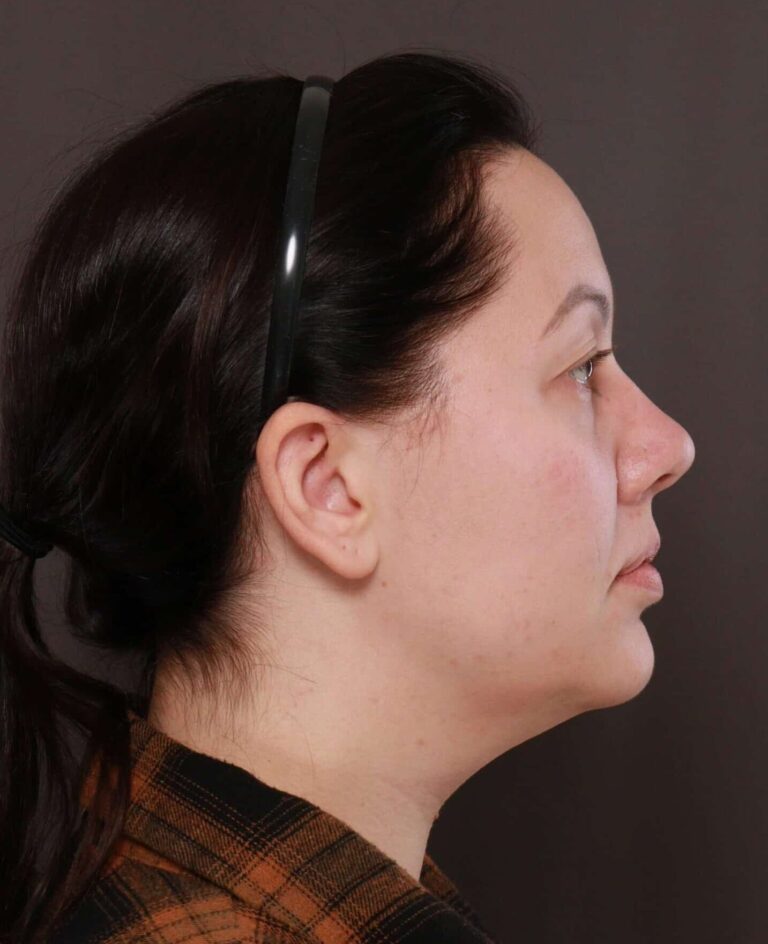 Before Image: Deep Neck Contouring by Dr. Manning - right-side