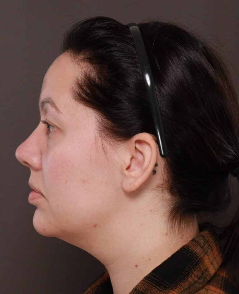 Before Image: Deep Neck Contouring by Dr. Manning - left-side