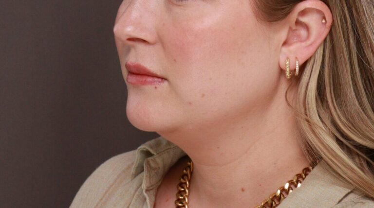 Before Image: Deep Neck Contouring by Dr. Manning - left-front-oblique