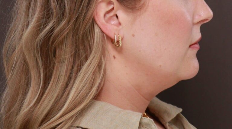 Before Image: Deep Neck Contouring by Dr. Manning - right-side