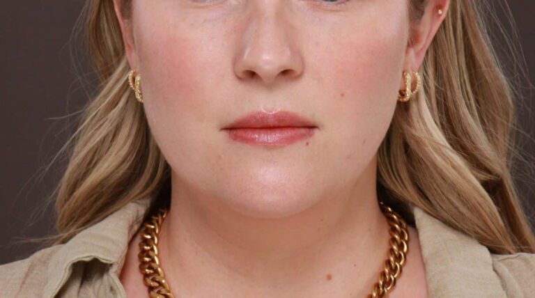 Before Image: Deep Neck Contouring by Dr. Manning -