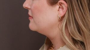 Before Image: Deep Neck Contouring by Dr. Manning