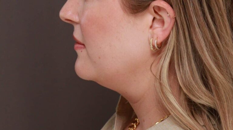 Before Image: Deep Neck Contouring by Dr. Manning - left-side
