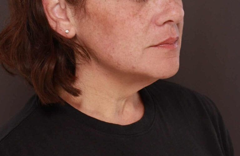 Before Image: Deep Neck Contouring by Dr. Manning - right-front-oblique