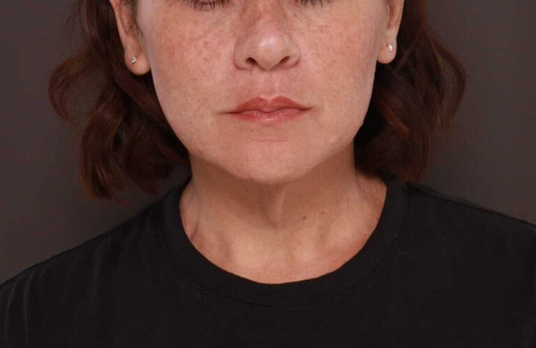 Before Image: Deep Neck Contouring by Dr. Manning - front