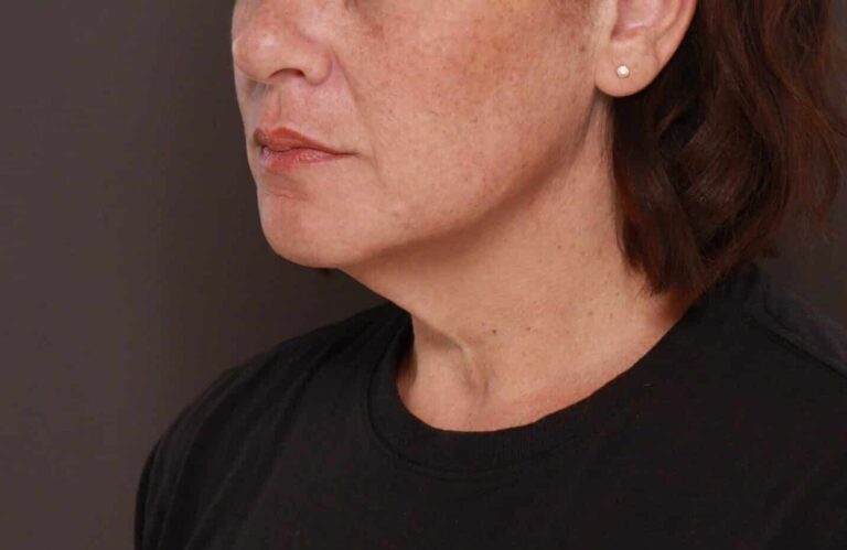 Before Image: Deep Neck Contouring by Dr. Manning - left-front-oblique