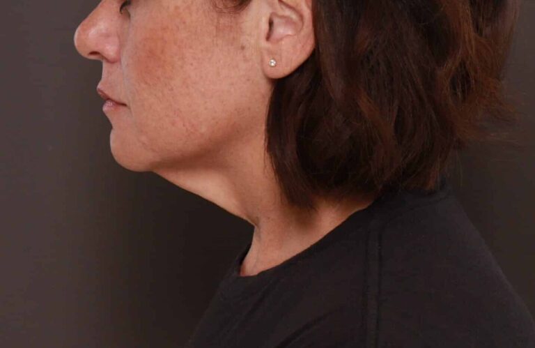 Before Image: Deep Neck Contouring by Dr. Manning - left-side