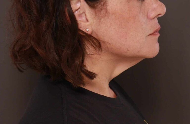 Before Image: Deep Neck Contouring by Dr. Manning - right-side