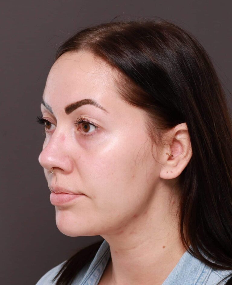 After Image: Deep Neck Contouring by Dr. Manning - left-front-oblique