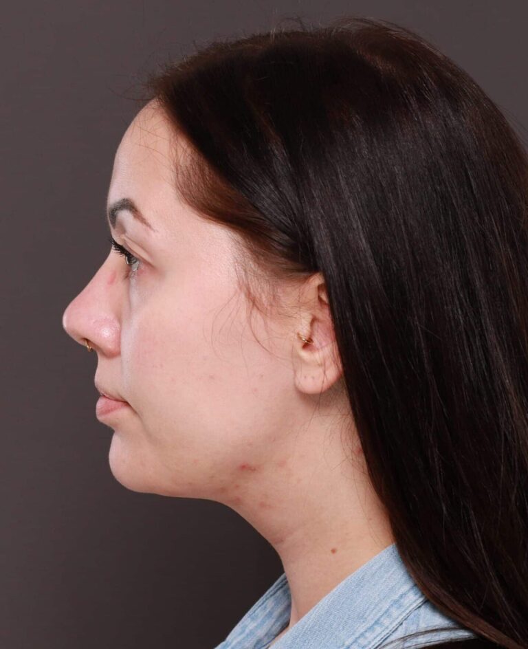 After Image: Deep Neck Contouring by Dr. Manning - left-side