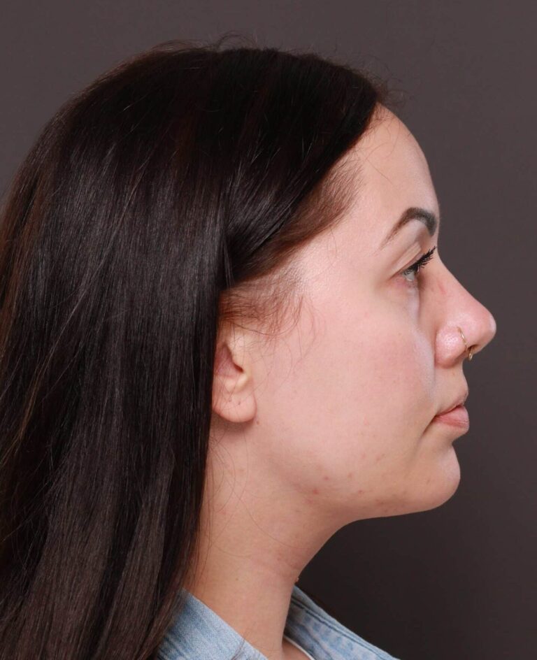 After Image: Deep Neck Contouring by Dr. Manning - right-side