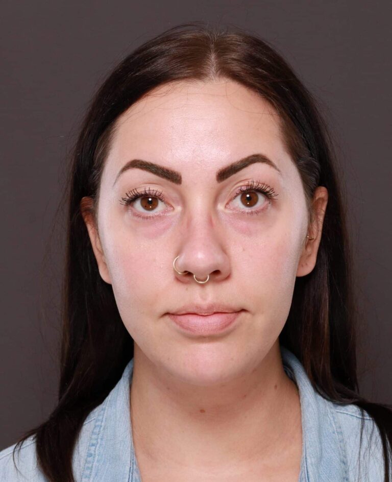 After Image: Deep Neck Contouring by Dr. Manning - front