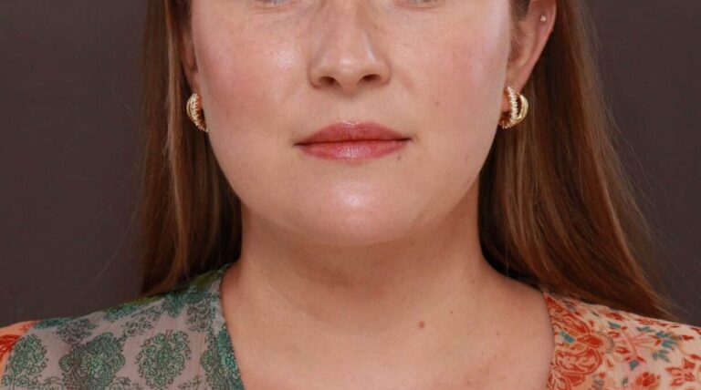 After Image: Deep Neck Contouring by Dr. Manning -