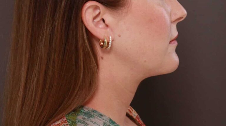 After Image: Deep Neck Contouring by Dr. Manning - right-side