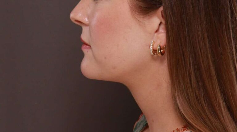 After Image: Deep Neck Contouring by Dr. Manning - left-side