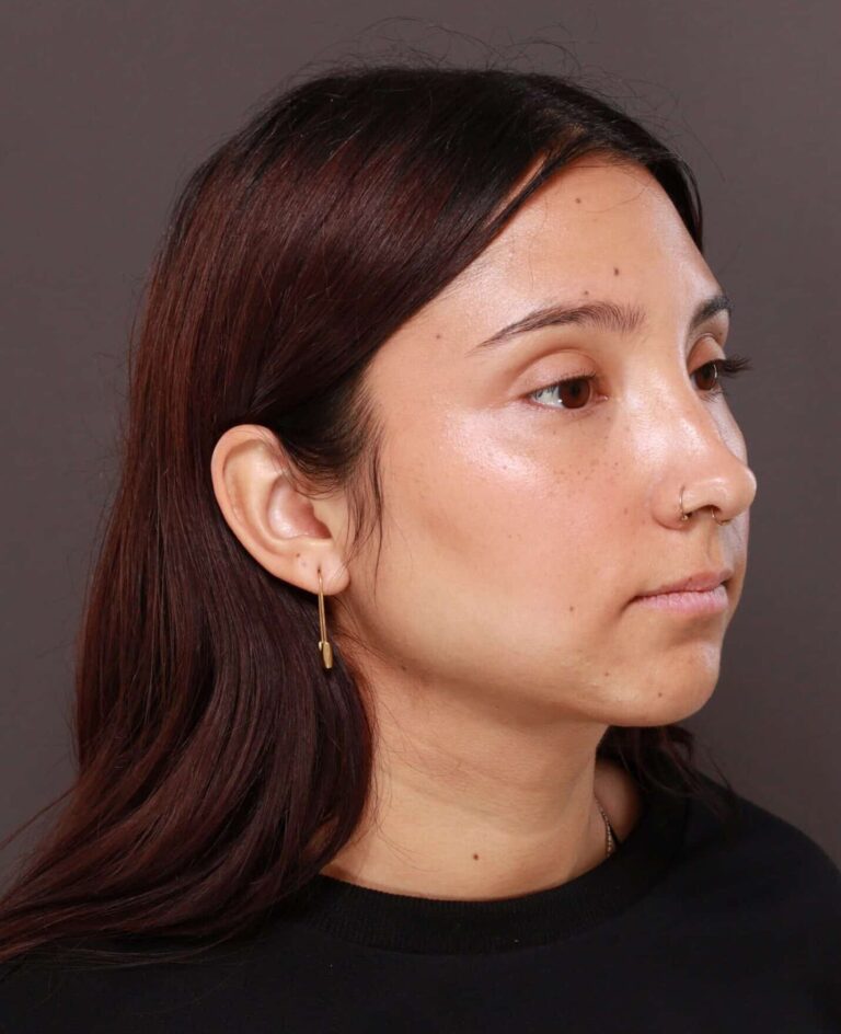 After Image: Deep Neck Contouring by Dr. Manning - right-front-oblique
