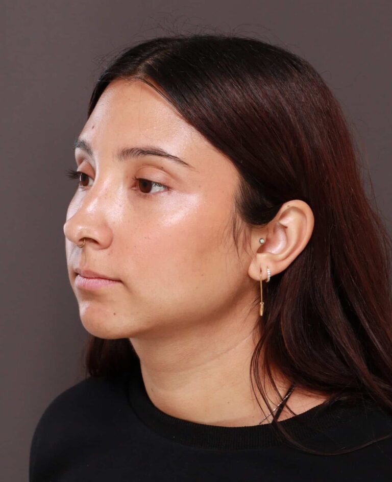 After Image: Deep Neck Contouring by Dr. Manning - left-front-oblique