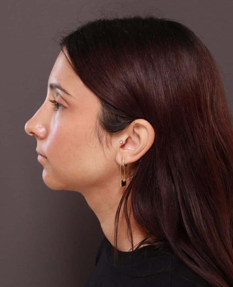 After Image: Deep Neck Contouring by Dr. Manning - front
