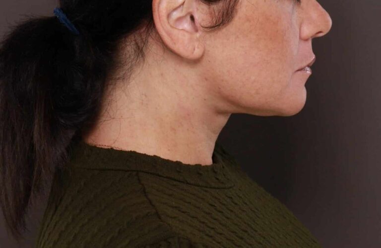 After Image: Deep Neck Contouring by Dr. Manning - right-side