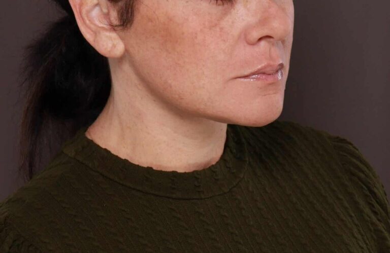 After Image: Deep Neck Contouring by Dr. Manning - right-front-oblique