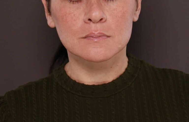 After Image: Deep Neck Contouring by Dr. Manning - front