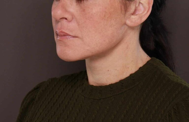 After Image: Deep Neck Contouring by Dr. Manning - left-front-oblique