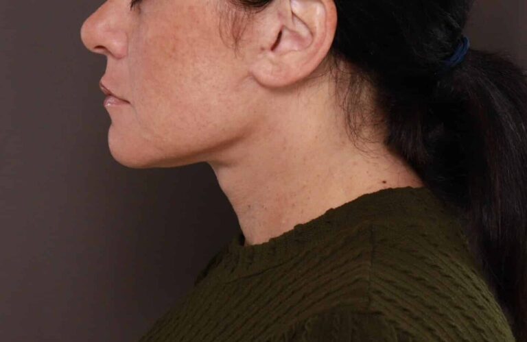 After Image: Deep Neck Contouring by Dr. Manning - left-side