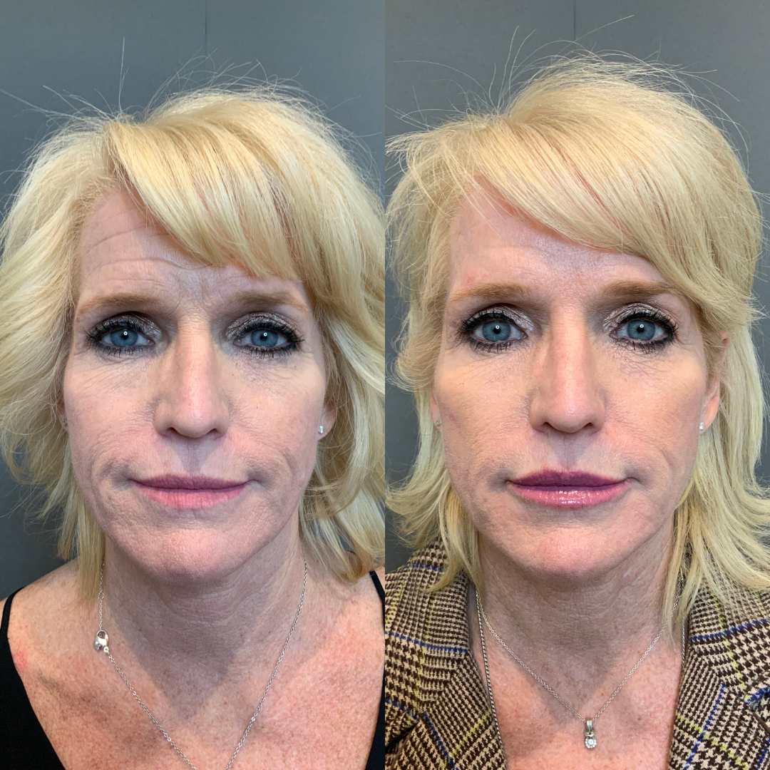 Utah facial plastics before after Sculptra Salt Lake City UT