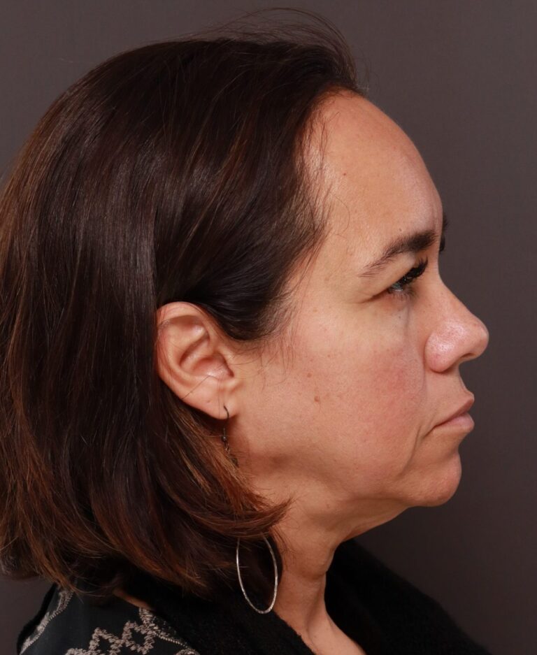 Before Image: Facelift, Forehead Reduction, Upper Blepharoplasty by Dr. Thompson - right-side