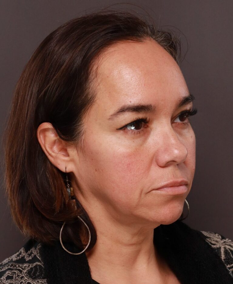 Before Image: Facelift, Forehead Reduction, Upper Blepharoplasty by Dr. Thompson - right-front-oblique