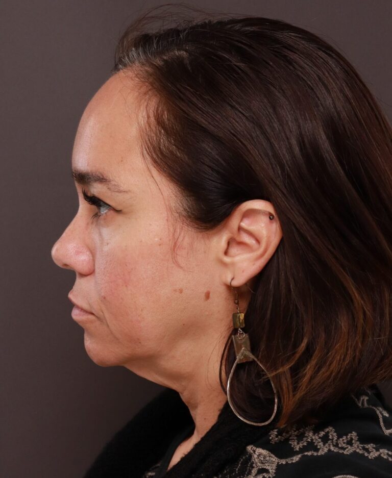Before Image: Facelift, Forehead Reduction, Upper Blepharoplasty by Dr. Thompson - left-side