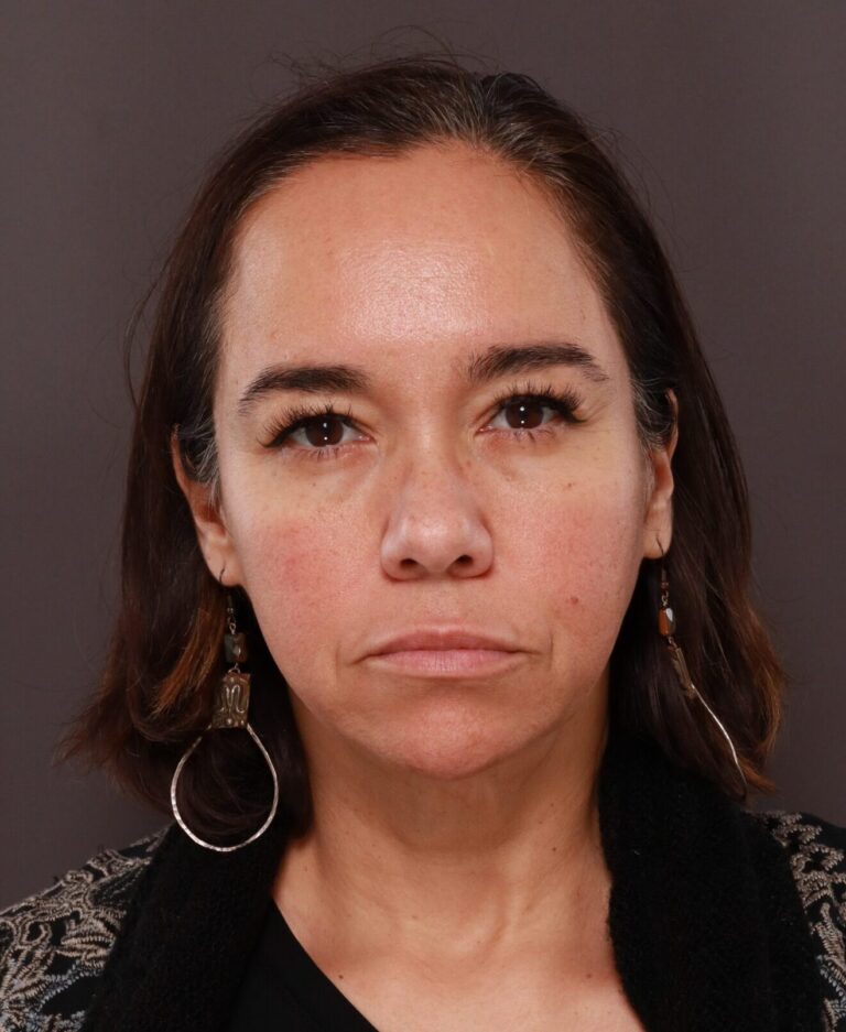 Before Image: Facelift, Forehead Reduction, Upper Blepharoplasty by Dr. Thompson - front