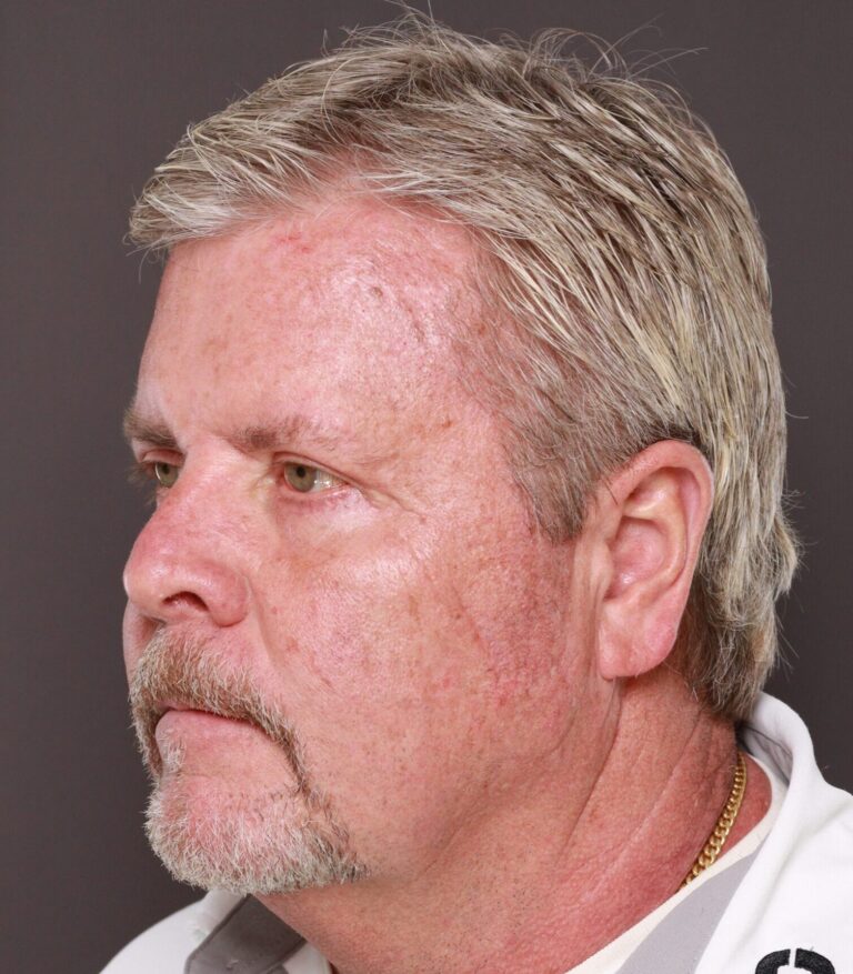 After Image: Upper & Lower Blepharoplasty with Fat Repositioning by Dr. Henstrom - left-front-oblique