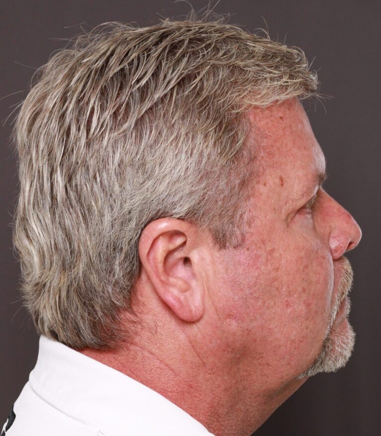 After Image: Upper & Lower Blepharoplasty with Fat Repositioning by Dr. Henstrom -