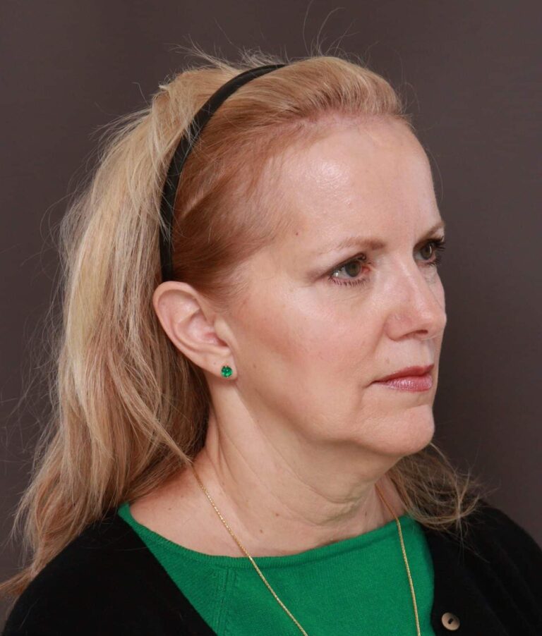 Before Image: Facelift by Dr. Thompson - right-front-oblique
