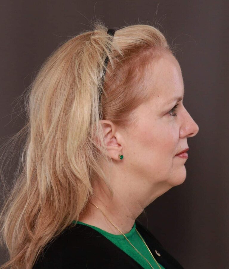 Before Image: Facelift by Dr. Thompson - right-side